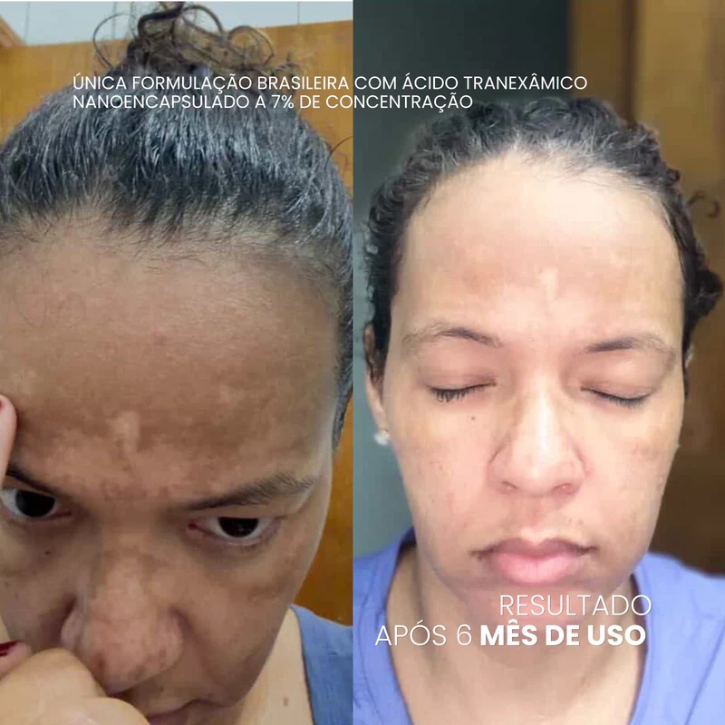 Antes e depois — Sandra